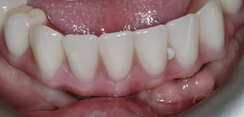 Patient after dental implants