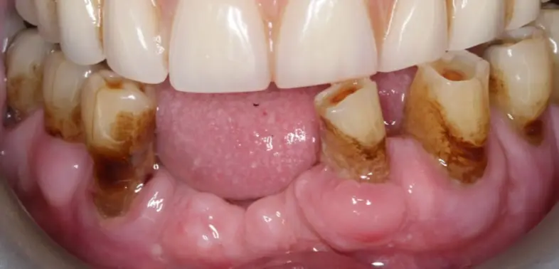 Patient before dental implants